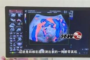脐带剪断与结扎安全操作与解开可能性分析