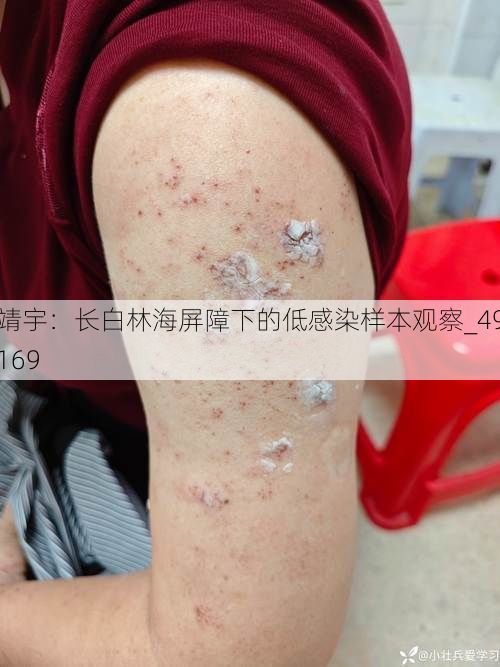 靖宇：长白林海屏障下的低感染样本观察_49169