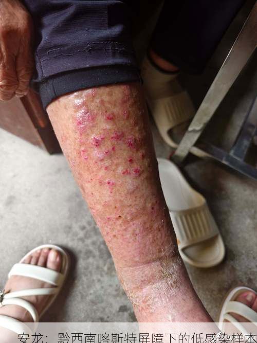 安龙：黔西南喀斯特屏障下的低感染样本