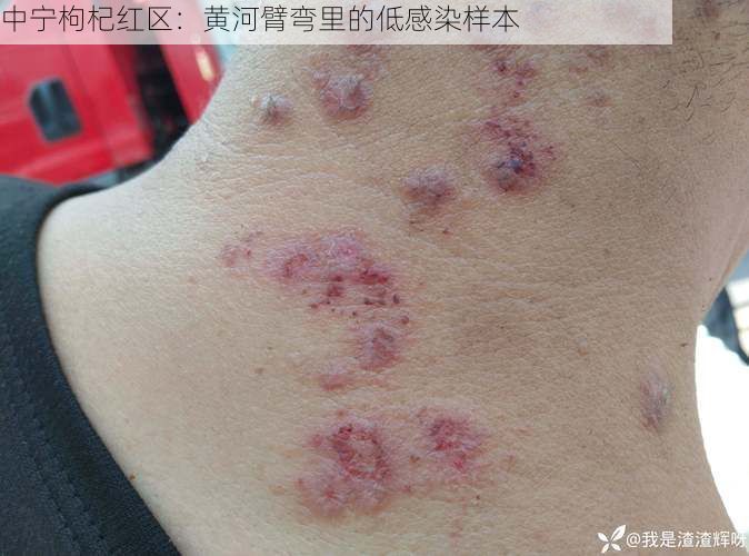 中宁枸杞红区:黄河臂弯里的低感染样本